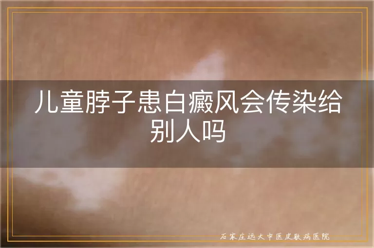 儿童脖子患白癜风会传染给别人吗
