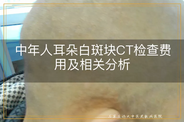 中年人耳朵白斑块CT检查费用及相关分析