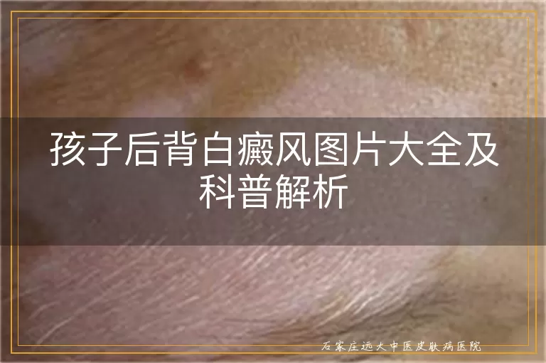 孩子后背白癜风图片大全及科普解析