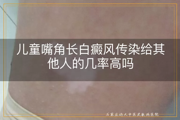 儿童嘴角长白癜风传染给其他人的几率高吗