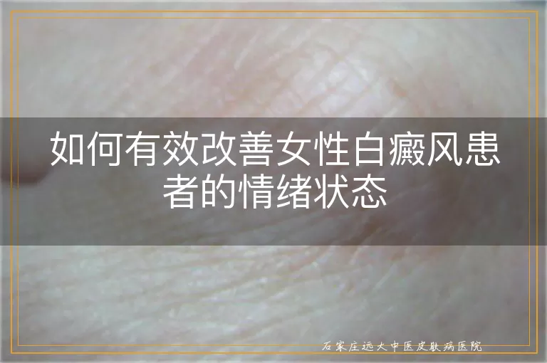 如何有效改善女性白癜风患者的情绪状态