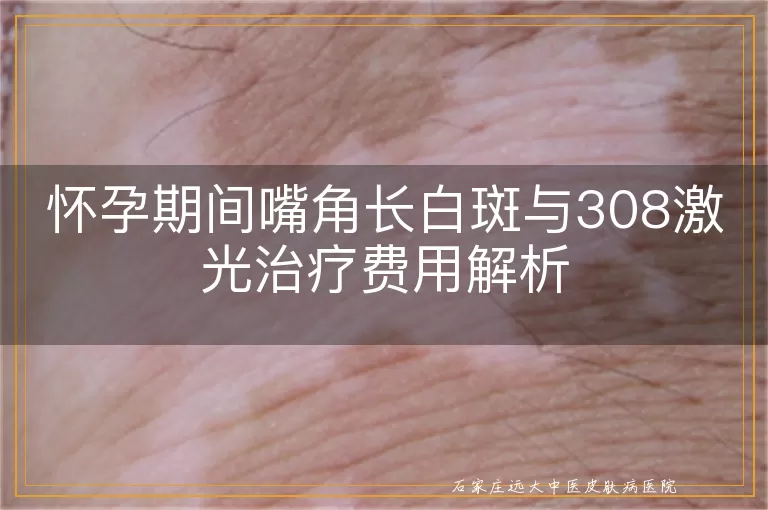 怀孕期间嘴角长白斑与308激光治疗费用解析