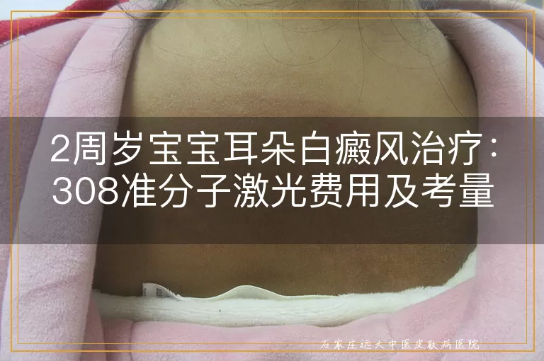 2周岁宝宝耳朵白癜风治疗：308准分子激光费用及考量