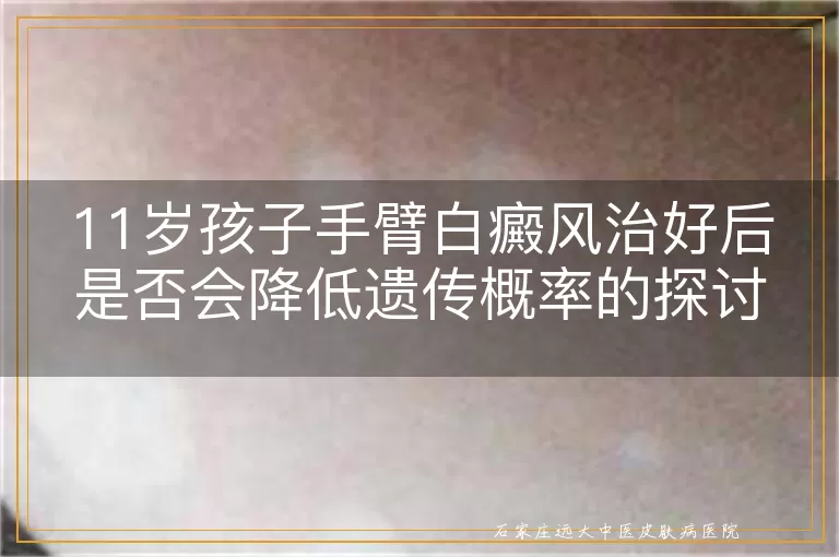 11岁孩子手臂白癜风治好后是否会降低遗传概率的探讨