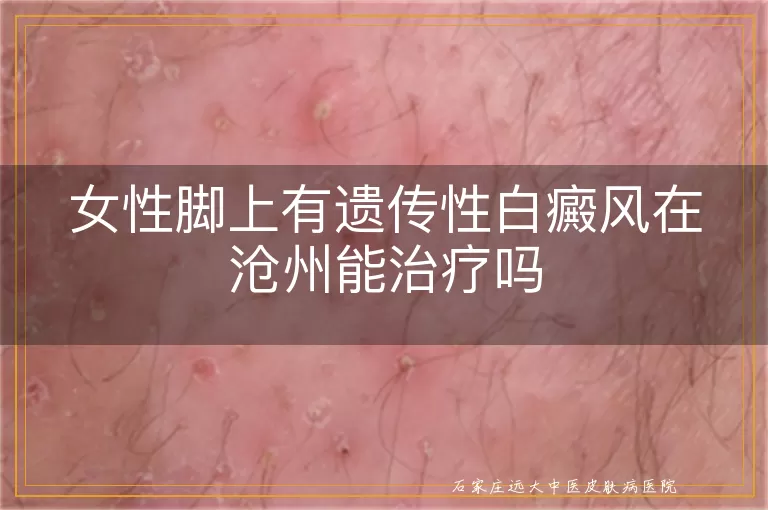 女性脚上有遗传性白癜风在沧州能治疗吗