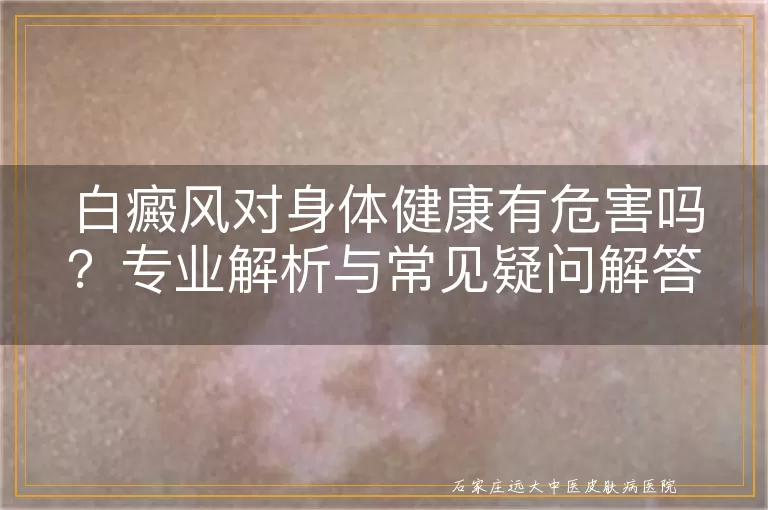 白癜风对身体健康有危害吗？专业解析与常见疑问解答