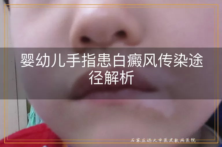 婴幼儿手指患白癜风传染途径解析