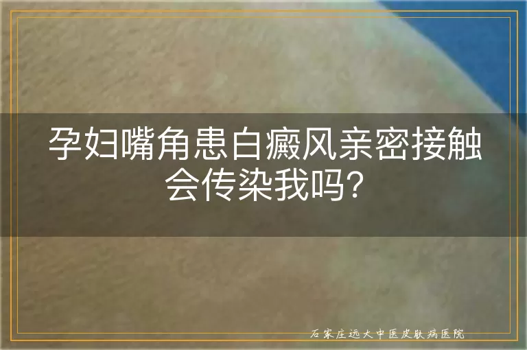 孕妇嘴角患白癜风亲密接触会传染我吗？