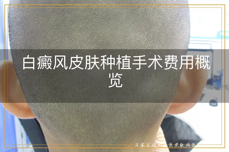 白癜风皮肤种植手术费用概览