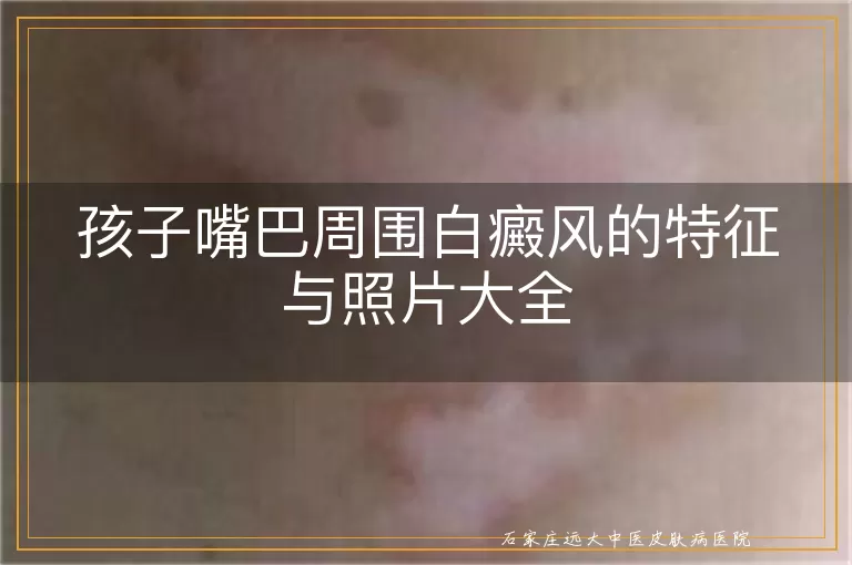 孩子嘴巴周围白癜风的特征与照片大全