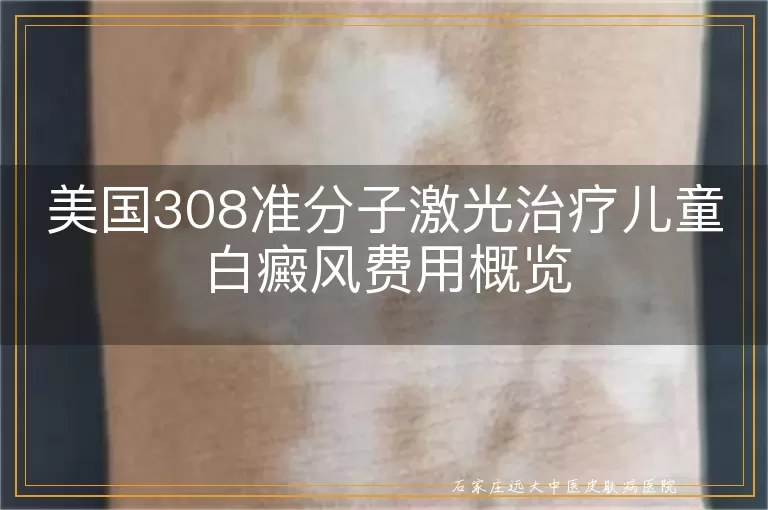 美国308准分子激光治疗儿童白癜风费用概览