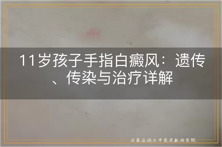 11岁孩子手指白癜风：遗传、传染与治疗详解