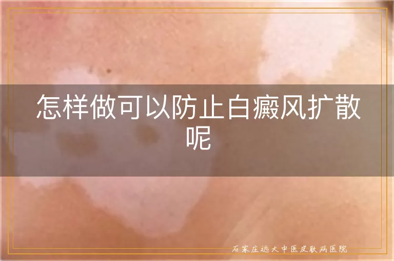 怎样做可以防止白癜风扩散呢