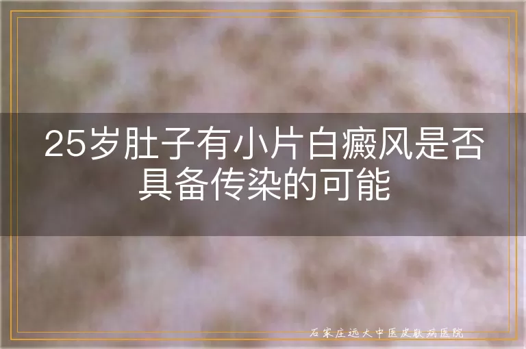 25岁肚子有小片白癜风是否具备传染的可能