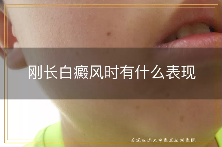 刚长白癜风时有什么表现