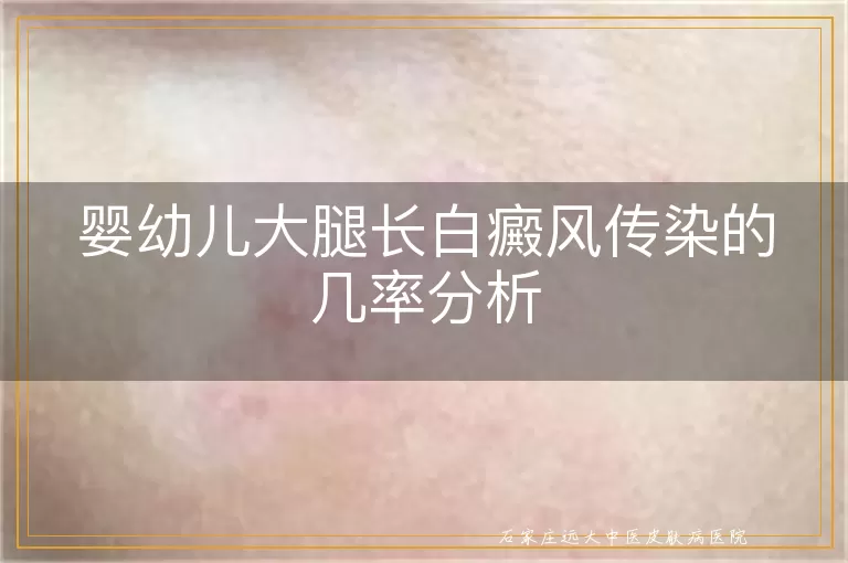 婴幼儿大腿长白癜风传染的几率分析