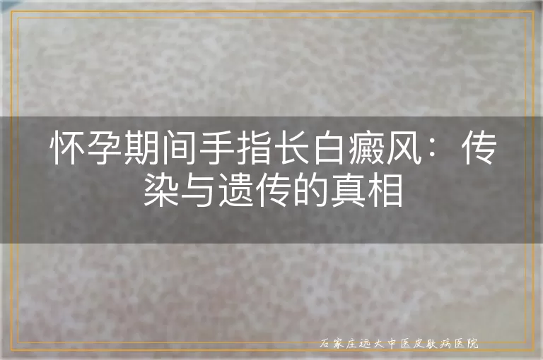 怀孕期间手指长白癜风：传染与遗传的真相