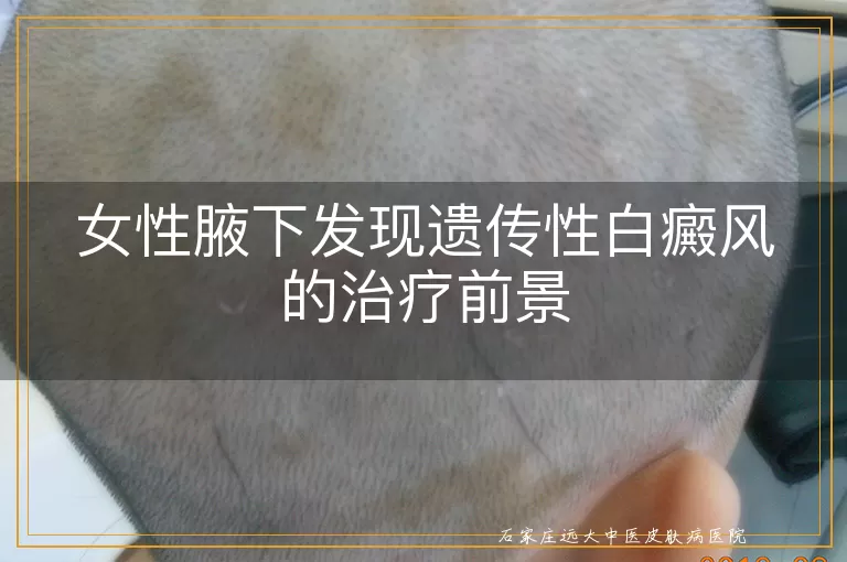女性腋下发现遗传性白癜风的治疗前景