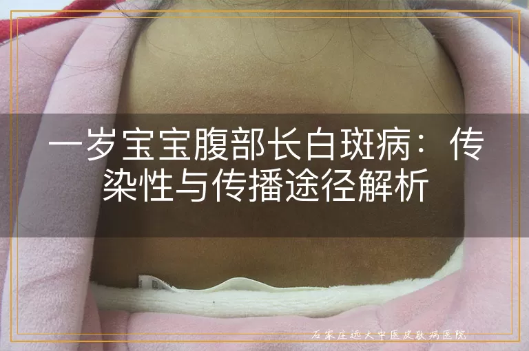 一岁宝宝腹部长白斑病：传染性与传播途径解析