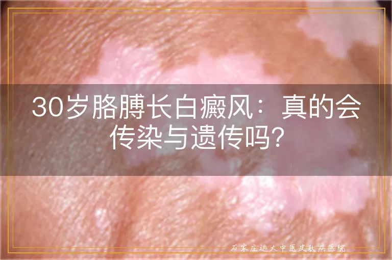 30岁胳膊长白癜风：真的会传染与遗传吗？