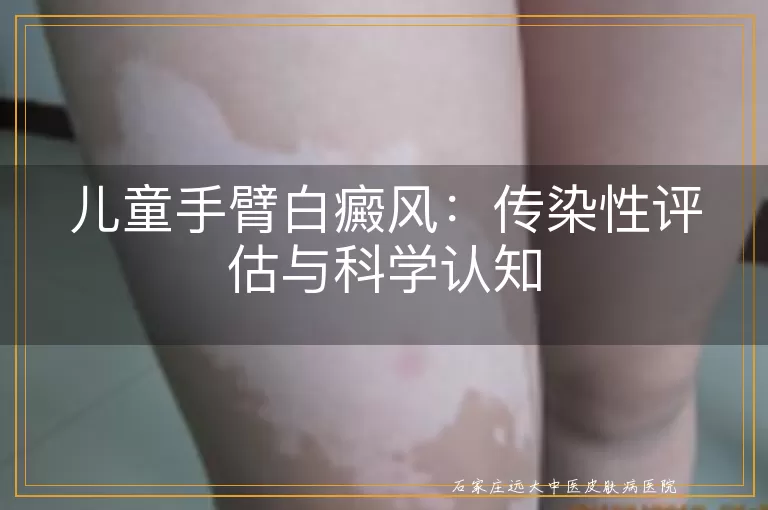 儿童手臂白癜风：传染性评估与科学认知