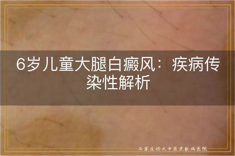 6岁儿童大腿白癜风：疾病传染性解析