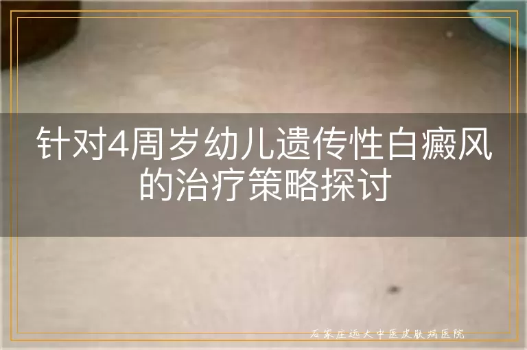 针对4周岁幼儿遗传性白癜风的治疗策略探讨