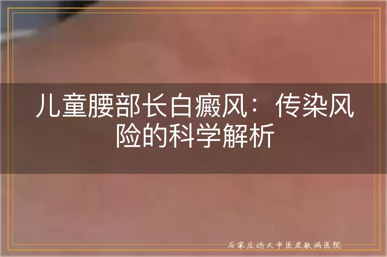 儿童腰部长白癜风：传染风险的科学解析