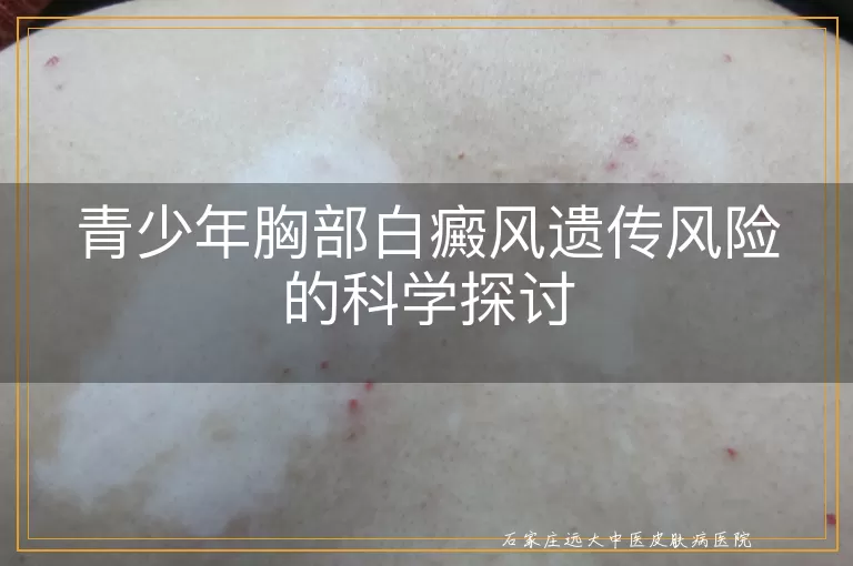 青少年胸部白癜风遗传风险的科学探讨