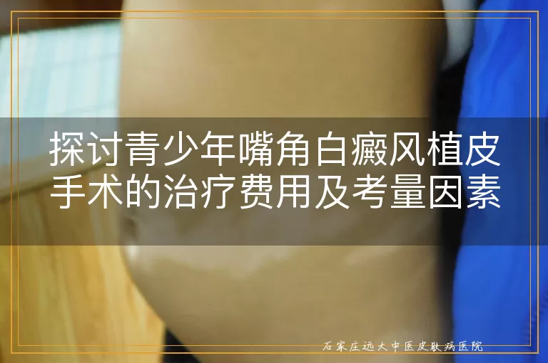 探讨青少年嘴角白癜风植皮手术的治疗费用及考量因素