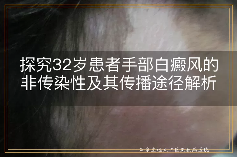 探究32岁患者手部白癜风的非传染性及其传播途径解析