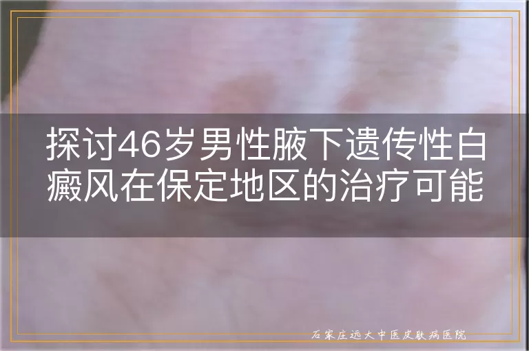 探讨46岁男性腋下遗传性白癜风在保定地区的治疗可能性
