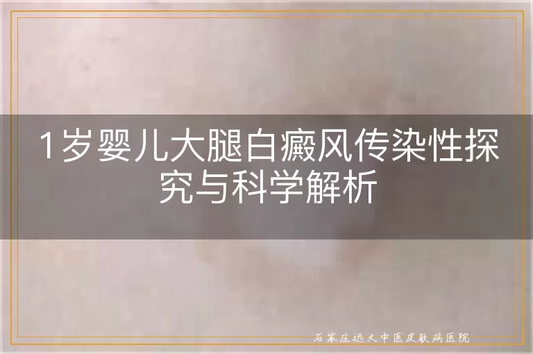 1岁婴儿大腿白癜风传染性探究与科学解析