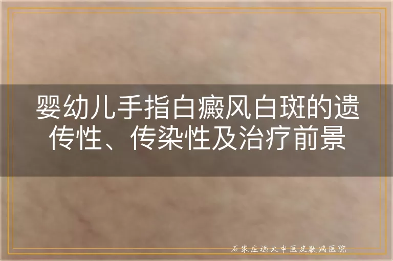 婴幼儿手指白癜风白斑的遗传性、传染性及治疗前景