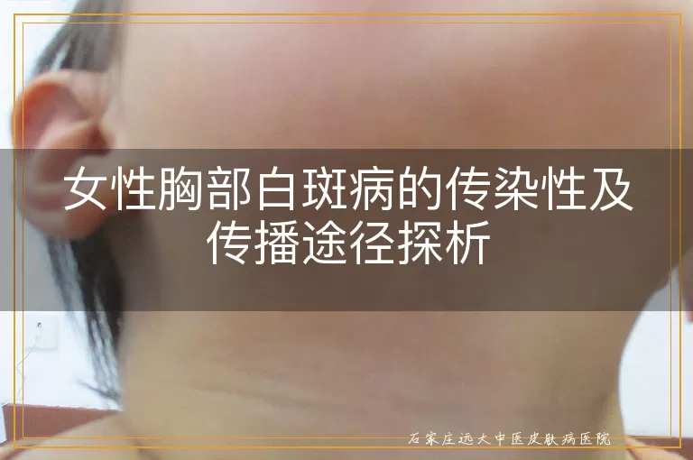 女性胸部白斑病的传染性及传播途径探析