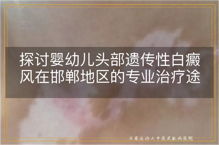 探讨婴幼儿头部遗传性白癜风在邯郸地区的专业治疗途径