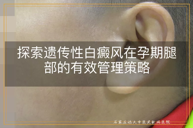 探索遗传性白癜风在孕期腿部的有效管理策略
