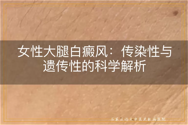 女性大腿白癜风：传染性与遗传性的科学解析