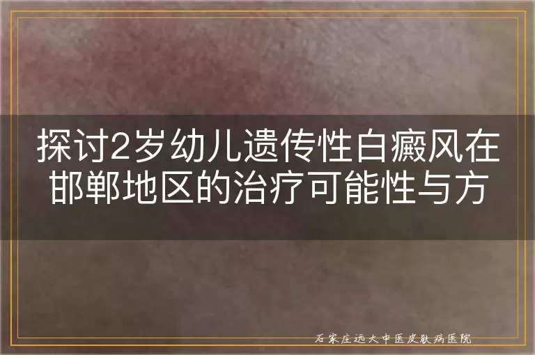 探讨2岁幼儿遗传性白癜风在邯郸地区的治疗可能性与方案