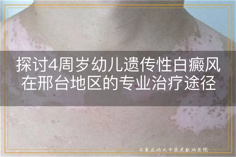探讨4周岁幼儿遗传性白癜风在邢台地区的专业治疗途径