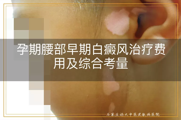 孕期腰部早期白癜风治疗费用及综合考量