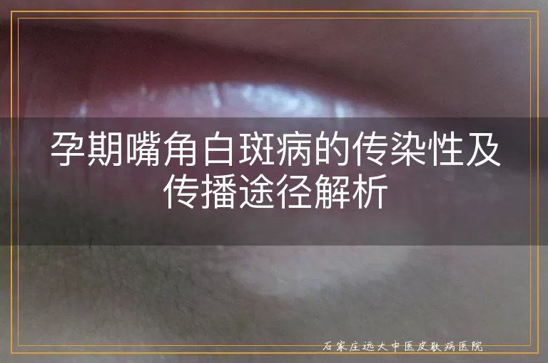 孕期嘴角白斑病的传染性及传播途径解析