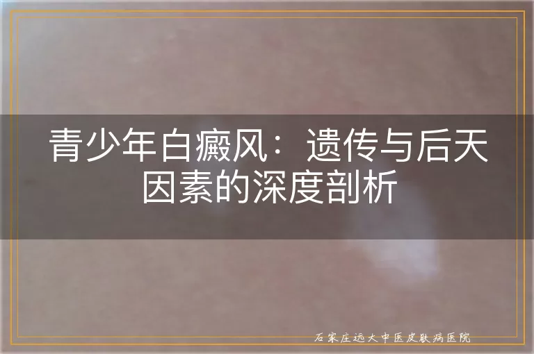 青少年白癜风：遗传与后天因素的深度剖析