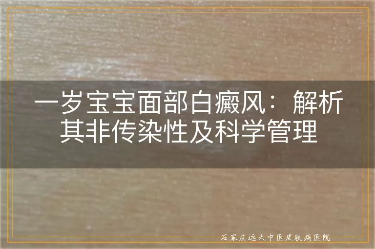 一岁宝宝面部白癜风：解析其非传染性及科学管理