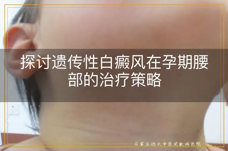 探讨遗传性白癜风在孕期腰部的治疗策略