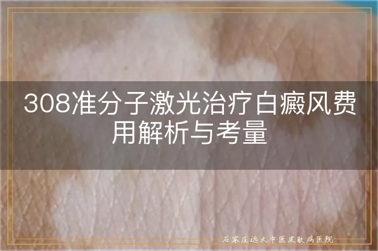 308准分子激光治疗白癜风费用解析与考量