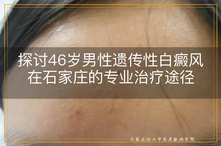 探讨46岁男性遗传性白癜风在石家庄的专业治疗途径