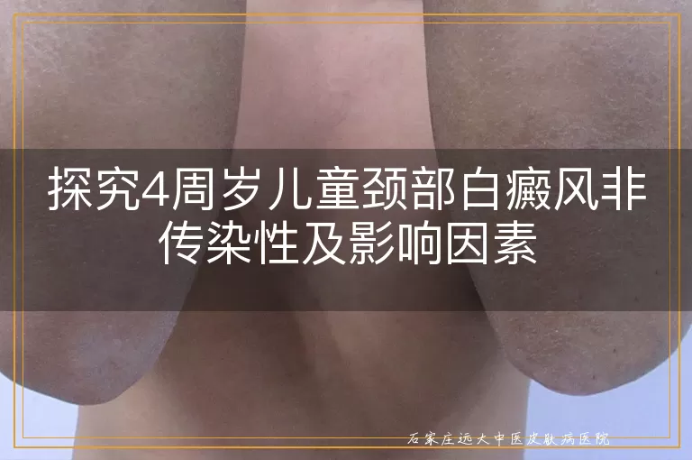 探究4周岁儿童颈部白癜风非传染性及影响因素
