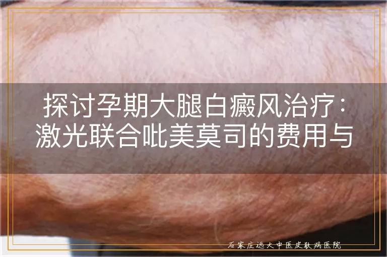 探讨孕期大腿白癜风治疗：激光联合吡美莫司的费用与效果分析