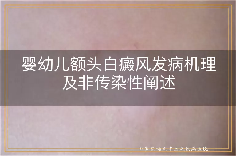 婴幼儿额头白癜风发病机理及非传染性阐述